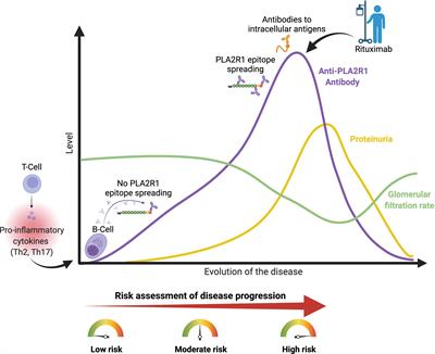 Frontiers Advances In The Management Of Primary Membranous